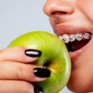 Apparecchio denti e alimentazione sportiva