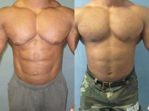 gynecomastie-avant-apres-super-steroid